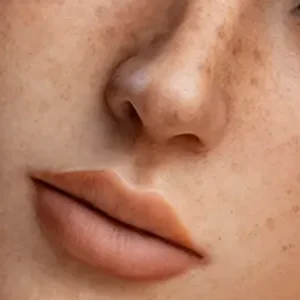 Freckle
